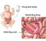 Chẩn đoán đau bụng cấp tính ở trẻ em